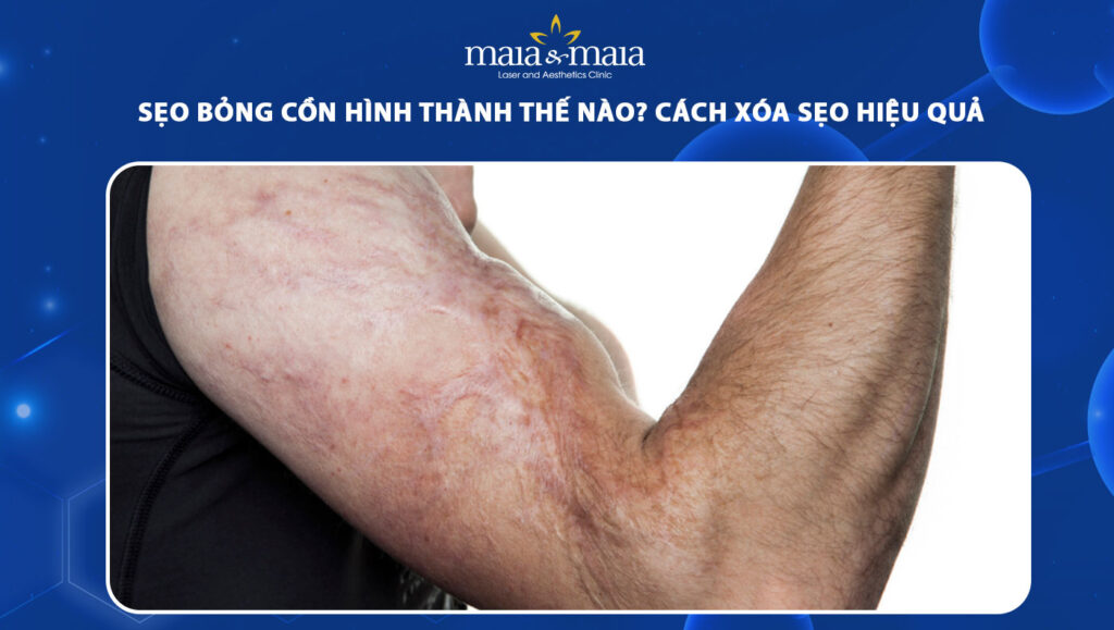 sẹo bỏng cồn