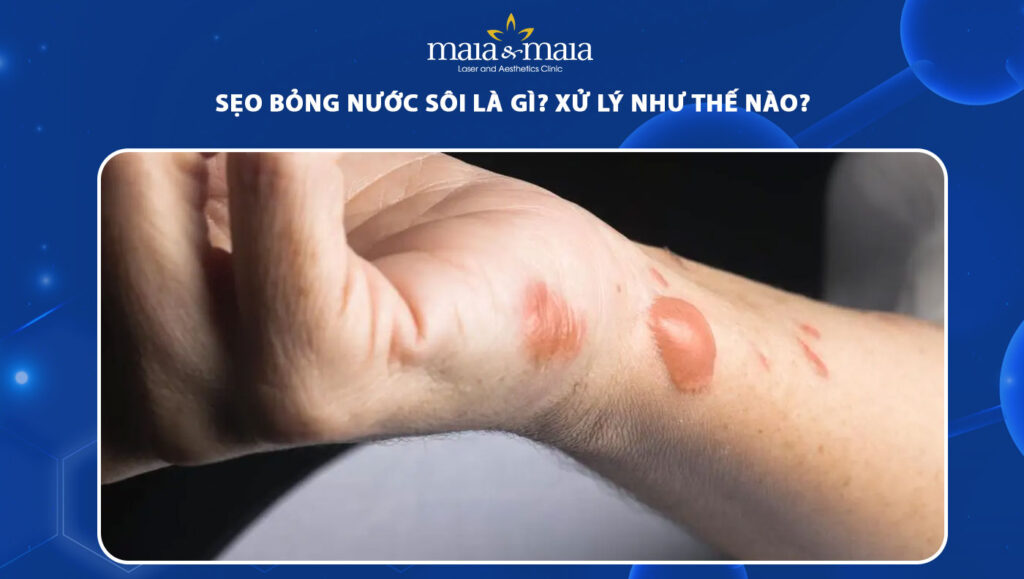 Sẹo bỏng nước sôi: Hậu quả và cách điều trị sẹo dứt điểm 1 sẹo bỏng nước sôi