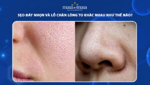 sẹo đáy nhọn và lỗ chân lông to