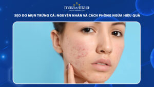 sẹo do mụn trứng cá