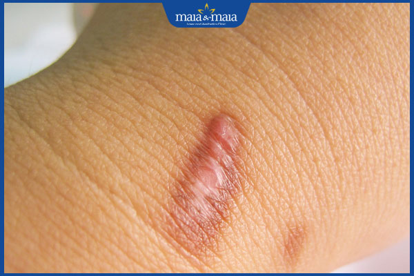 sẹo đỏ ở tay
