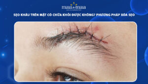 sẹo khâu trên mặt