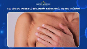sẹo lõm do tai nạn