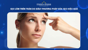 sẹo lõm trên trán
