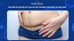 sẹo mổ lấy thai