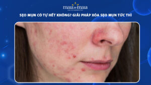 sẹo mụn có tự hết không