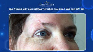 sẹo ở lông mày