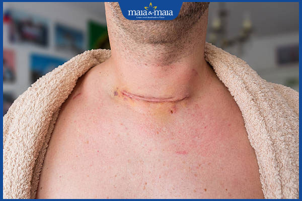 sẹo ở trên cổ