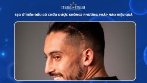 sẹo ở trên đầu