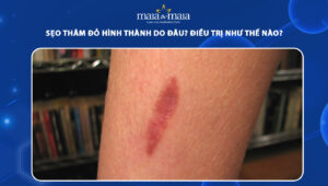 sẹo thâm đỏ