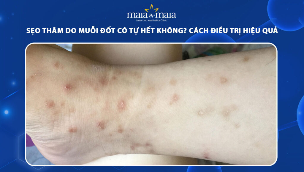 sẹo thâm do muỗi đốt