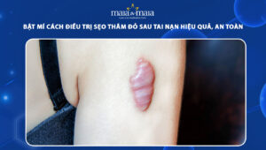 sẹo thâm đỏ sau tai nạn