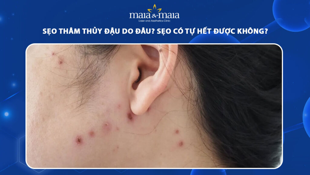 sẹo thâm thủy đậu