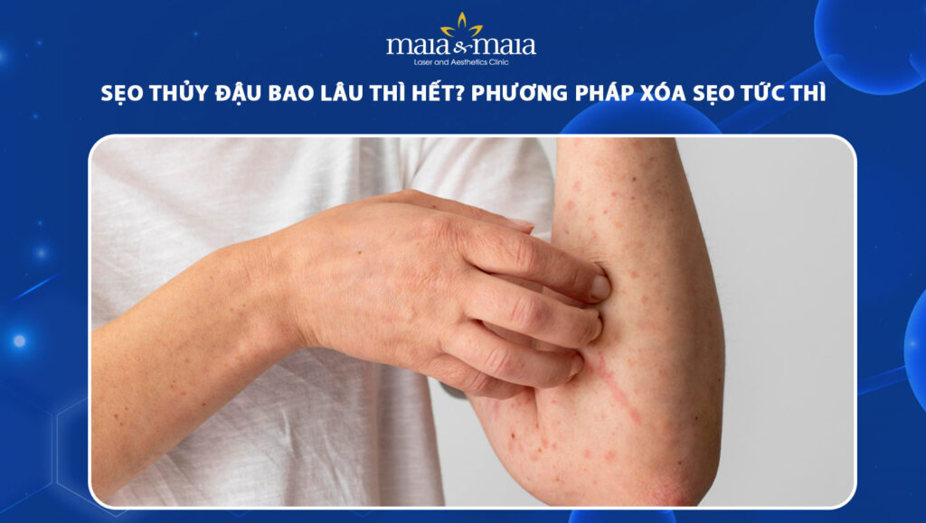 sẹo thủy đậu bao lâu thì hết