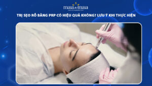 trị sẹo rỗ bằng prp