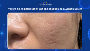 trị sẹo rỗ có đau không