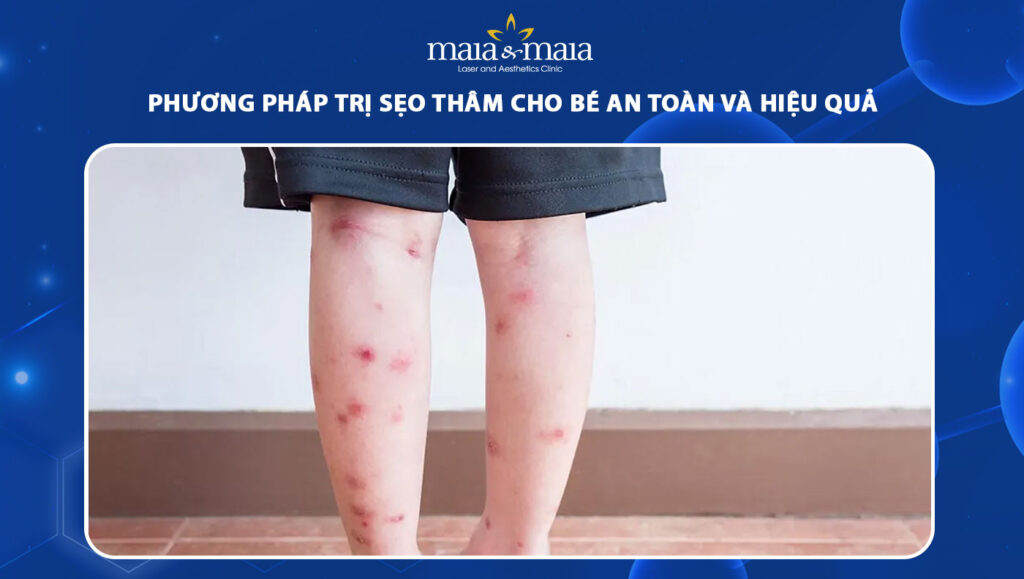 trị sẹo thâm cho bé