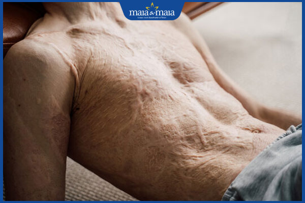Sẹo bỏng điều trị thế nào? Phòng ngừa vết bỏng thành sẹo 3 vết sẹo bỏng lớn