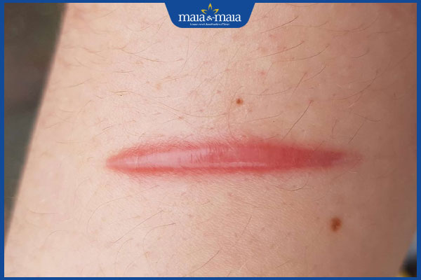 vết sẹo đỏ