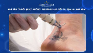 xóa xăm có để lại sẹo