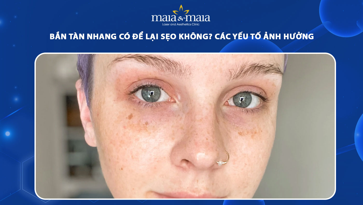 bắn tàn nhang có để lại sẹo không