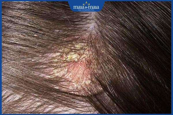 bệnh nấm da đầu