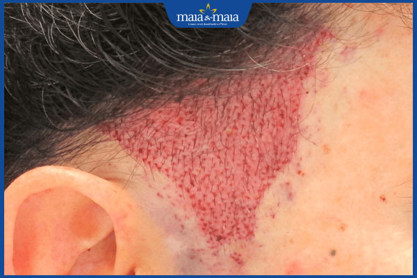 biểu hiện bình thường sau cấy tóc mai