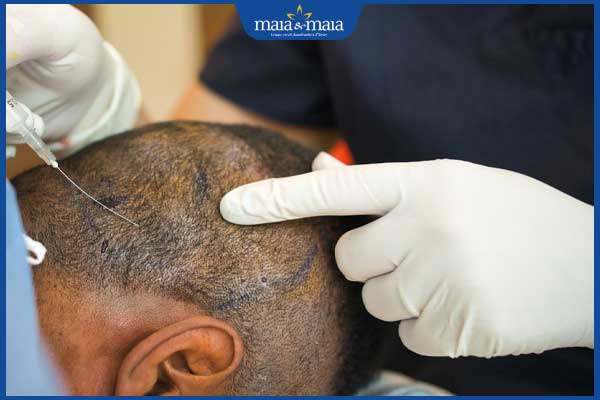 biểu hiện sau cấy tóc