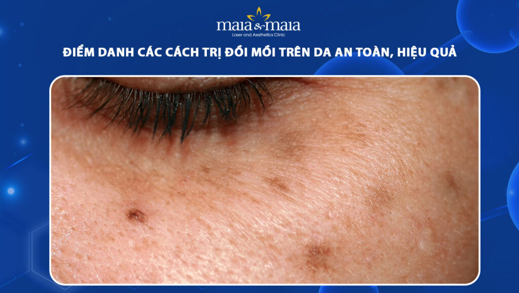 cách trị đồi mồi