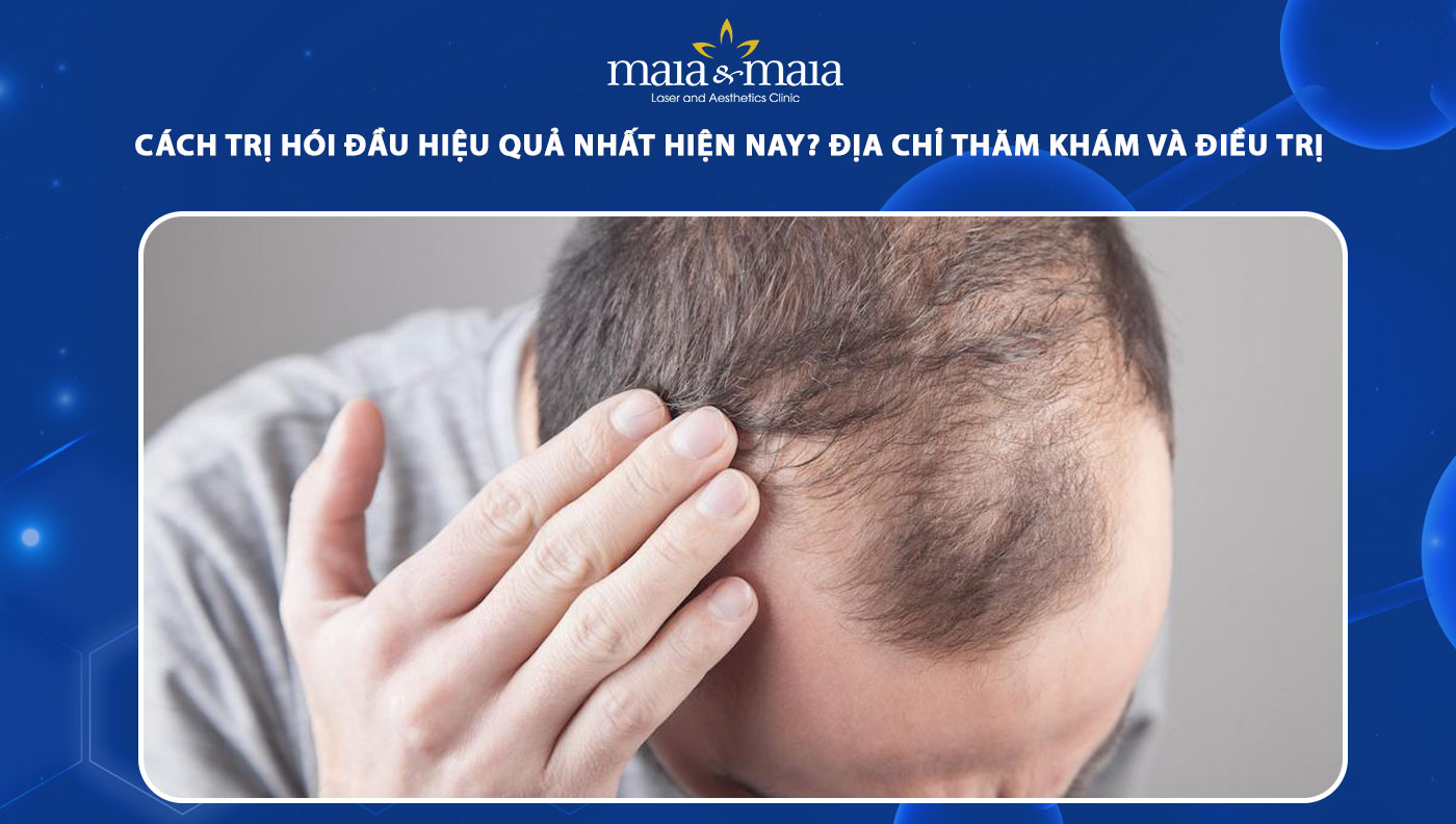 cách trị hói đầu