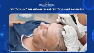 cấy tóc FUE