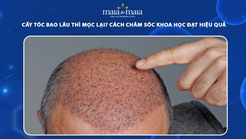 Cấy tóc bao lâu thì mọc lại? Cách chăm sóc để tóc nhanh mọc 1 cấy tóc bao lâu thì mọc lại