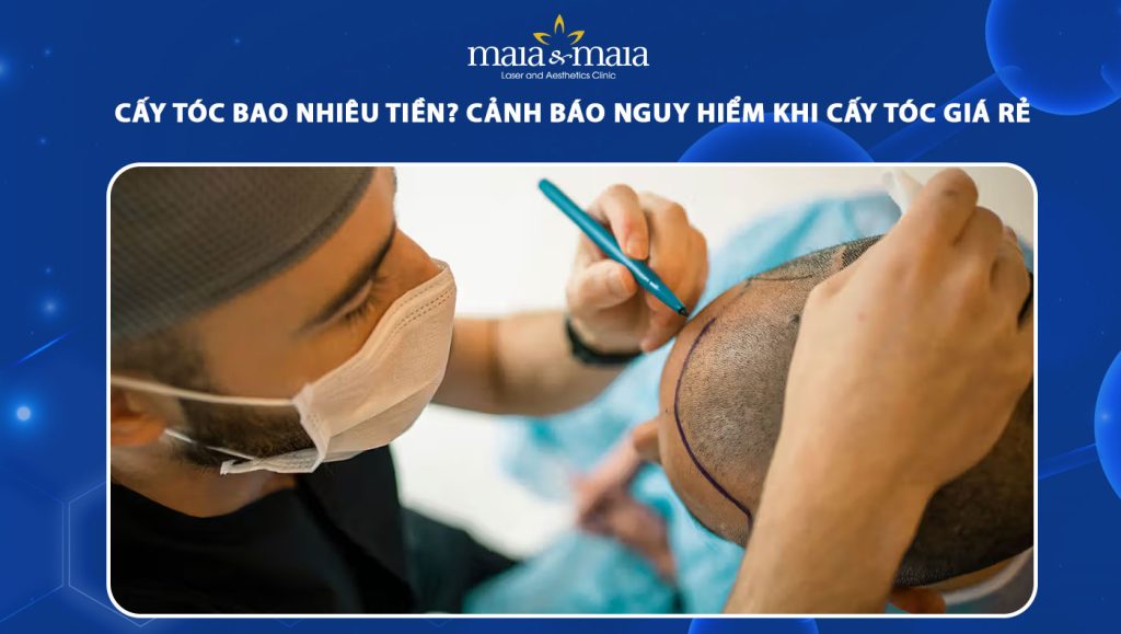 Cấy tóc bao nhiêu tiền? Cảnh báo nguy hiểm cấy tóc giá rẻ 1 cấy tóc bao nhiêu tiền