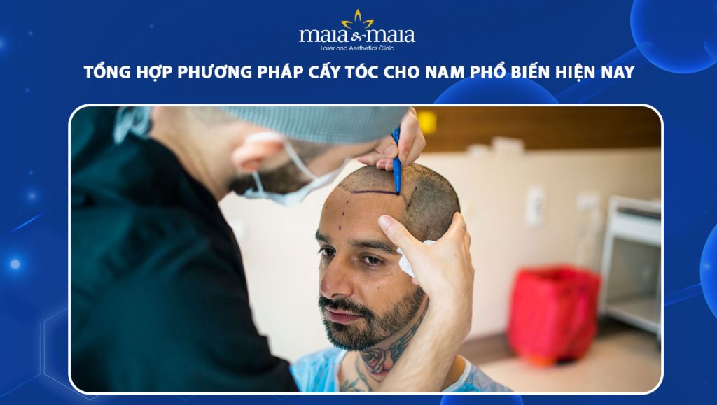 Các phương pháp cấy tóc cho nam và lưu ý khi thực hiện 1 cấy tóc cho nam