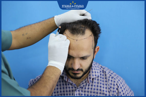 cấy tóc cho người trán cao