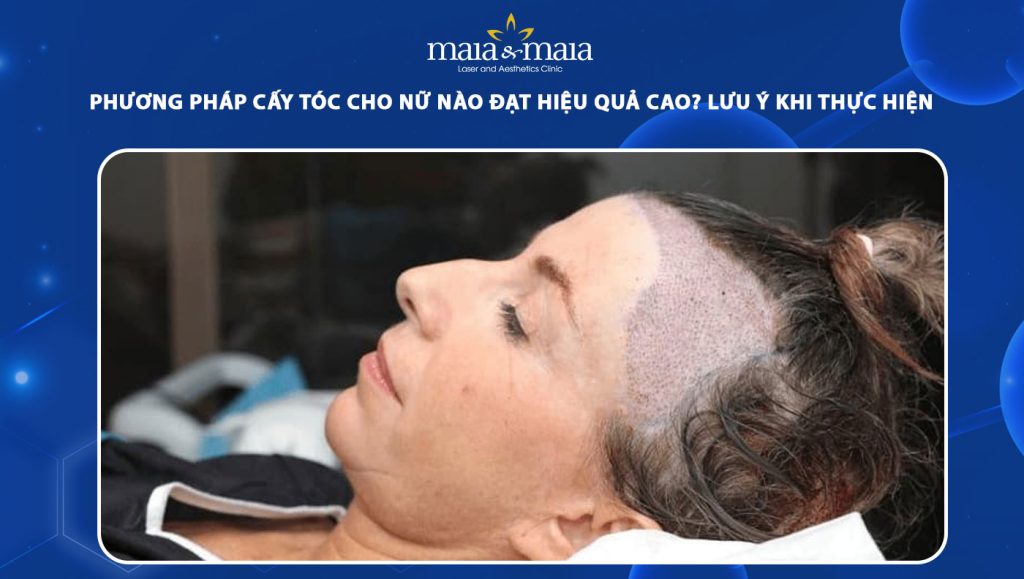 cấy tóc cho nữ
