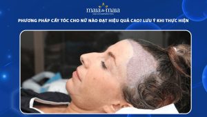 cấy tóc cho nữ