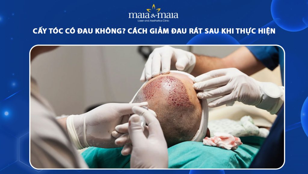 cấy tóc có đau không
