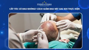 cấy tóc có đau không