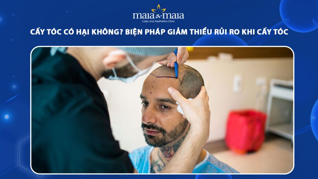 cấy tóc có hại không