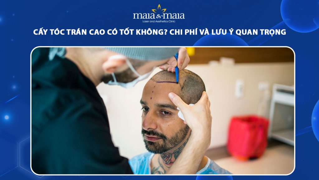 cấy tóc trán cao