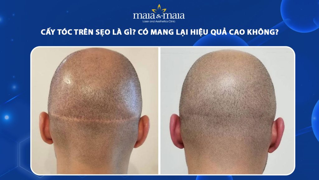 cáy tóc trên sẹo