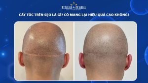 cáy tóc trên sẹo