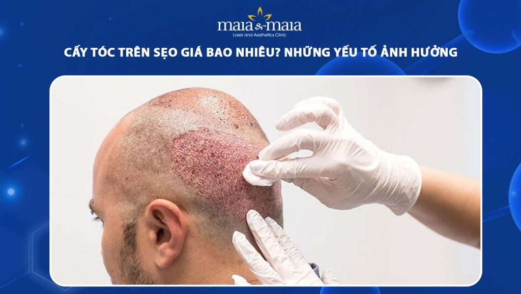 cấy tóc trên sẹo giá bao nhiêu