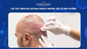 cấy tóc trên sẹo giá bao nhiêu