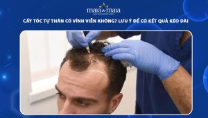 cấy tóc tự thân có vĩnh viễn không