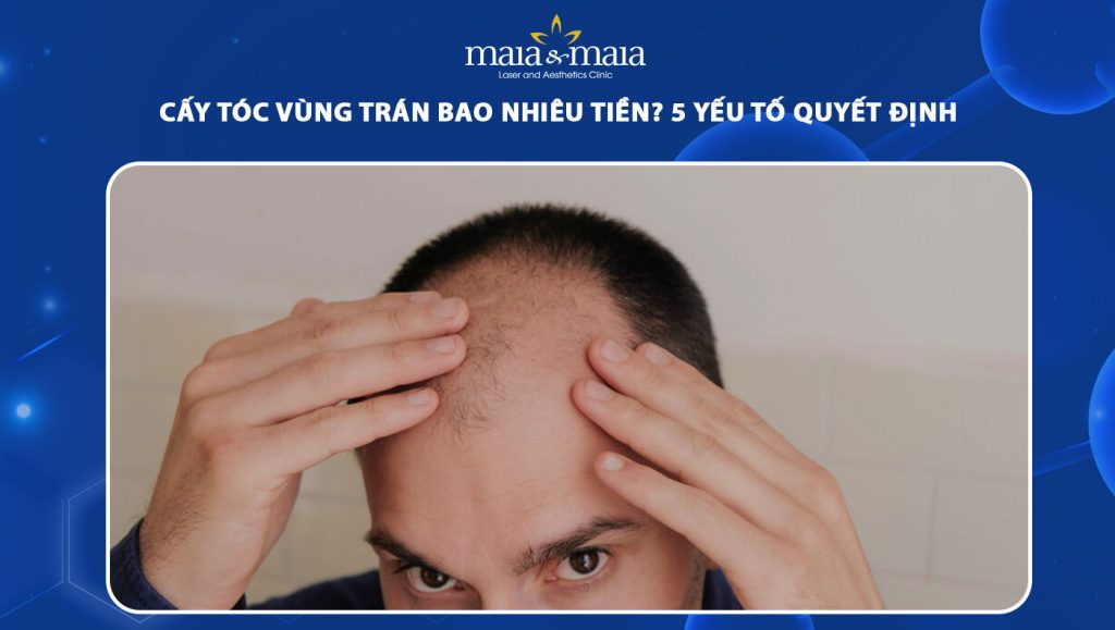 cấy tóc vùng trán bao nhiêu tiền