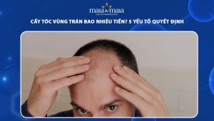 cấy tóc vùng trán bao nhiêu tiền