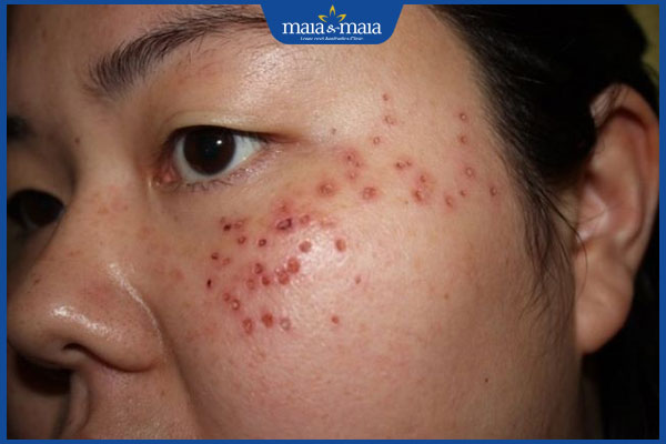 Chấm tàn nhang có tái lại không? Cách xóa tàn nhang dứt điểm 2 chấm axit xóa tàn nhang