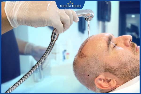 chăm sóc da đầu sau cấy